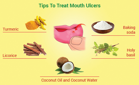 Tips To Treat Mouth Ulcers